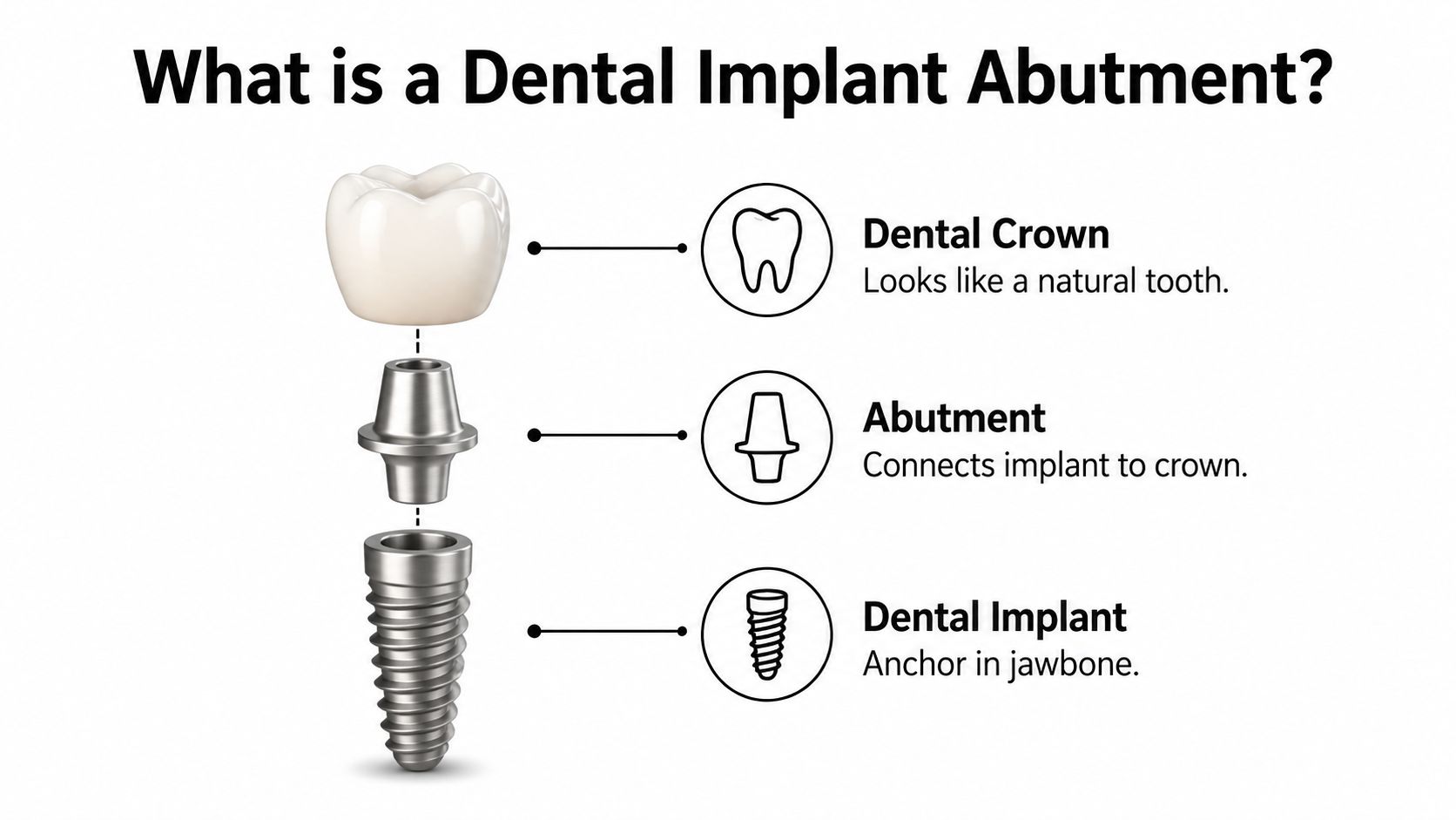 A diagram illustrating the three parts of a dental implant: the crown, the abutment, and the implant.