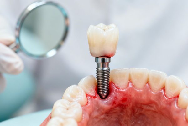 Dental Implant Failure